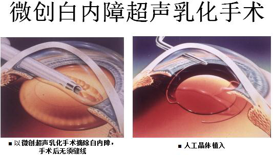 白內障,希瑪瑞視眼科,上海眼科醫(yī)院