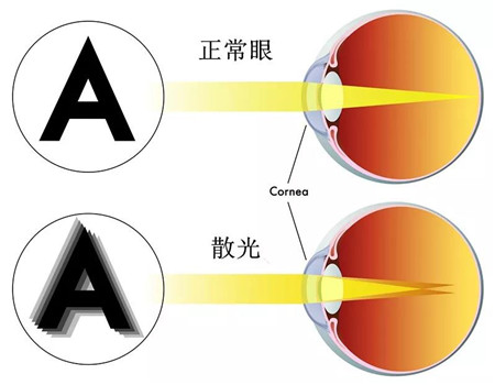 屈光矯視,希瑪瑞視眼科,上海眼科醫(yī)院