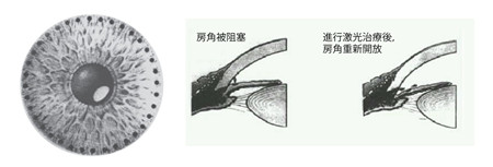 青光眼,?，斎鹨曆劭?上海眼科醫(yī)院