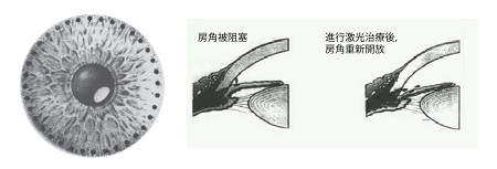 青光眼,希瑪瑞視眼科,上海眼科醫(yī)院