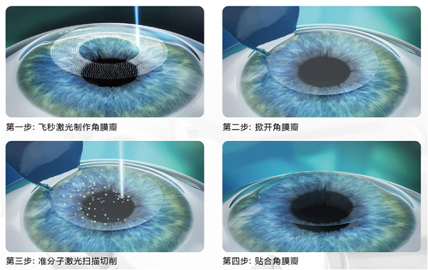 屈光矯視,希瑪瑞視眼科,上海眼科醫(yī)院