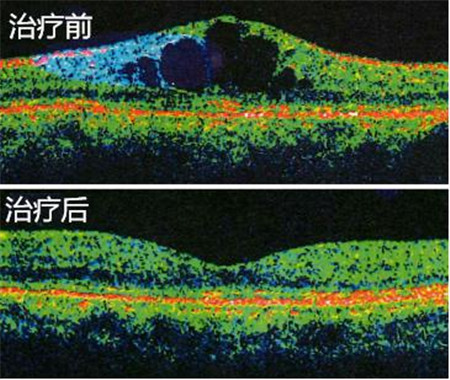 玻璃體視網(wǎng)膜,?，斎鹨曆劭?上海眼科醫(yī)院