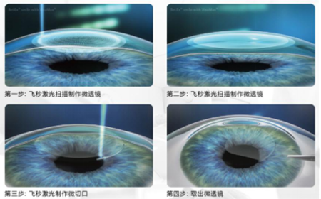 屈光矯視,?，斎鹨曆劭?上海眼科醫(yī)院