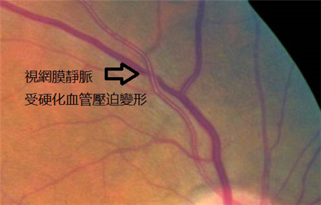 玻璃體視網(wǎng)膜,?，斎鹨曆劭?上海眼科醫(yī)院