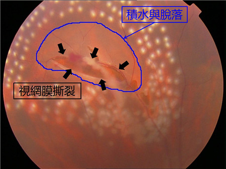 屈光矯視,?，斎鹨曆劭?上海眼科醫(yī)院