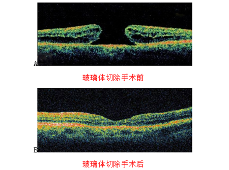 玻璃體視網(wǎng)膜,?，斎鹨曆劭?上海眼科醫(yī)院