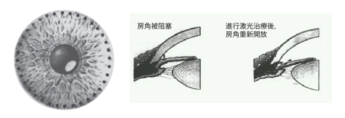 青光眼,希瑪瑞視眼科,上海眼科醫(yī)院