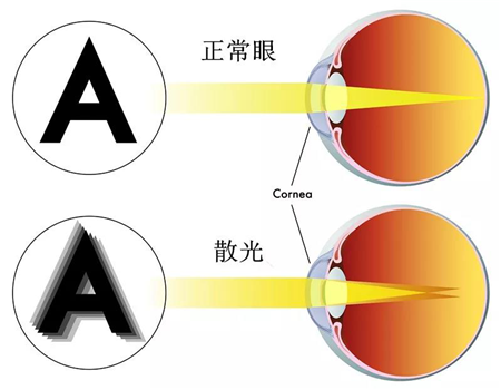 屈光矯視,?，斎鹨曆劭?上海眼科醫(yī)院