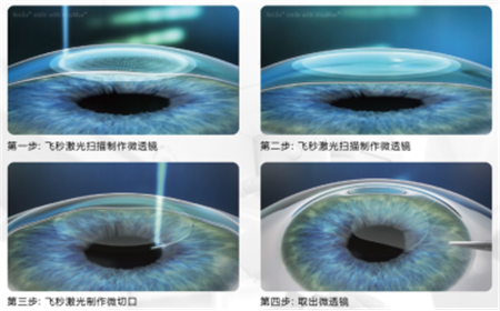 屈光矯視,?，斎鹨曆劭?上海眼科醫(yī)院