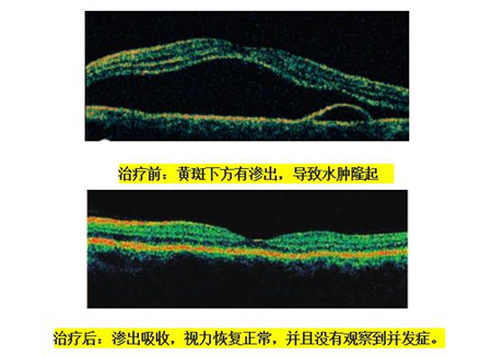 玻璃體視網(wǎng)膜,?，斎鹨曆劭?上海眼科醫(yī)院