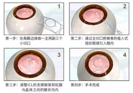 屈光矯視,?，斎鹨曆劭?上海眼科醫(yī)院