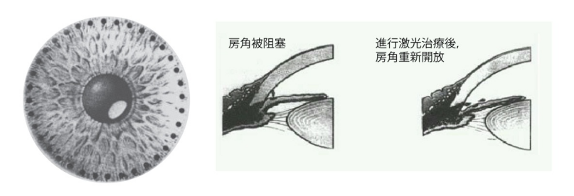 青光眼,希瑪瑞視眼科,上海眼科醫(yī)院
