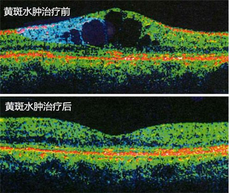 玻璃體視網(wǎng)膜,希瑪瑞視眼科,上海眼科醫(yī)院