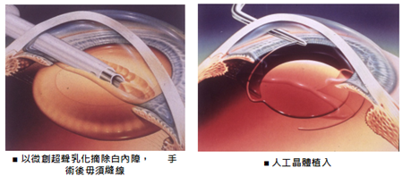 白內(nèi)障,?，斎鹨曆劭?上海眼科醫(yī)院