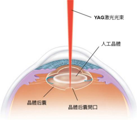 白內(nèi)障,希瑪瑞視眼科,上海眼科醫(yī)院