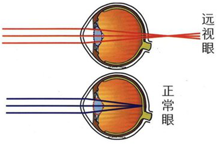 屈光矯視,?，斎鹨曆劭?上海眼科醫(yī)院