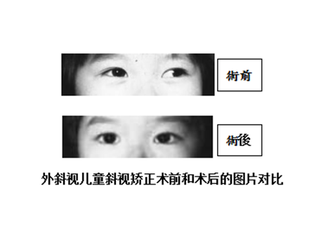 小兒眼病,希瑪瑞視眼科,上海眼科醫(yī)院