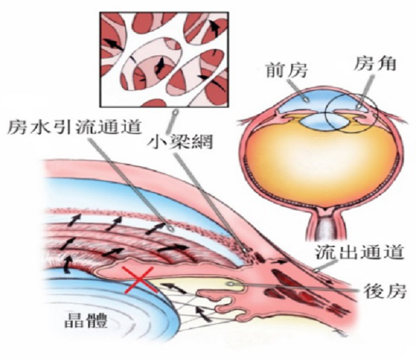 白內(nèi)障,?，斎鹨曆劭?上海眼科醫(yī)院