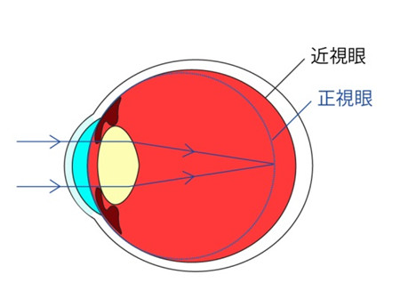 屈光矯視,希瑪瑞視眼科,上海眼科醫(yī)院