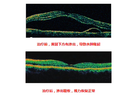 玻璃體視網(wǎng)膜,?，斎鹨曆劭?上海眼科醫(yī)院