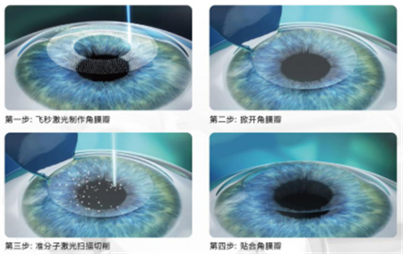 屈光矯視,?，斎鹨曆劭?上海眼科醫(yī)院