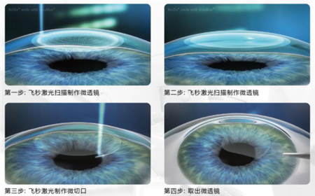 屈光矯視,希瑪瑞視眼科,上海眼科醫(yī)院