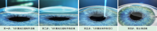 屈光矯視,?，斎鹨曆劭?上海眼科醫(yī)院