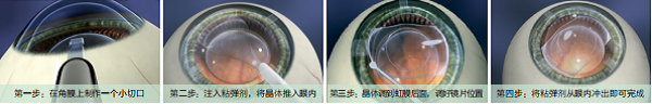 屈光矯視,希瑪瑞視眼科,上海眼科醫(yī)院