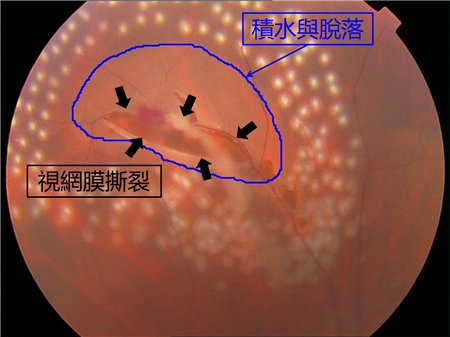 玻璃體視網(wǎng)膜,?，斎鹨曆劭?上海眼科醫(yī)院