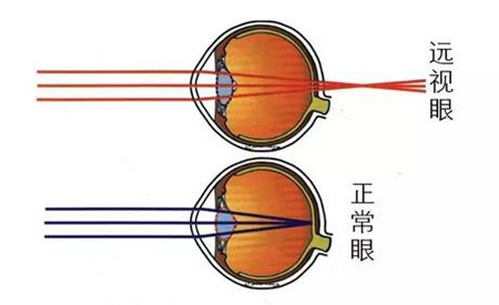屈光矯視,希瑪瑞視眼科,上海眼科醫(yī)院