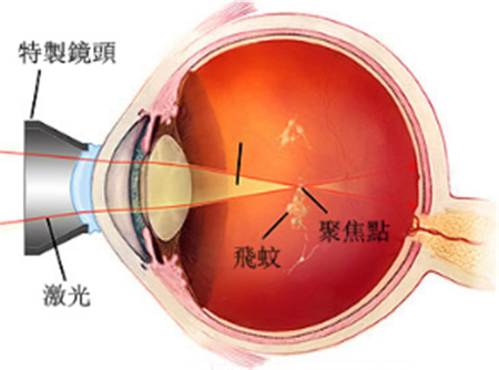 玻璃體視網(wǎng)膜,?，斎鹨曆劭?上海眼科醫(yī)院