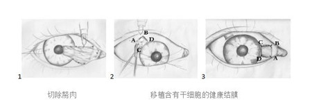 眼表眼角膜,?，斎鹨曆劭?上海眼科醫(yī)院