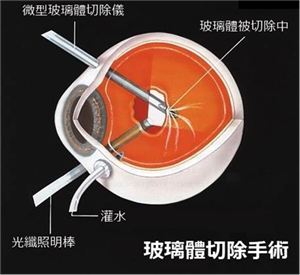 玻璃體視網(wǎng)膜,?，斎鹨曆劭?上海眼科醫(yī)院