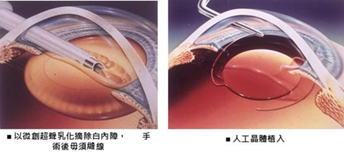 屈光矯視,希瑪瑞視眼科,上海眼科醫(yī)院