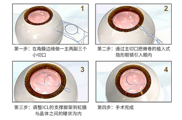 屈光矯視,希瑪瑞視眼科,上海眼科醫(yī)院