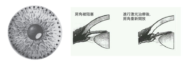 青光眼,?，斎鹨曆劭?上海眼科醫(yī)院